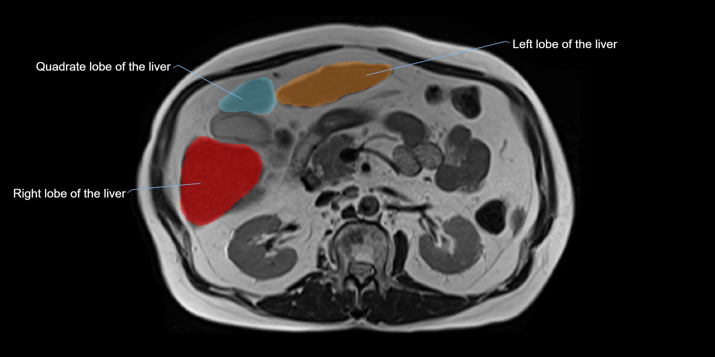 MRI liver lobe axial cross sectional 3T radiology  image-img-00001-00020.webp
